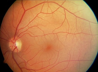 retinography in optica eixample